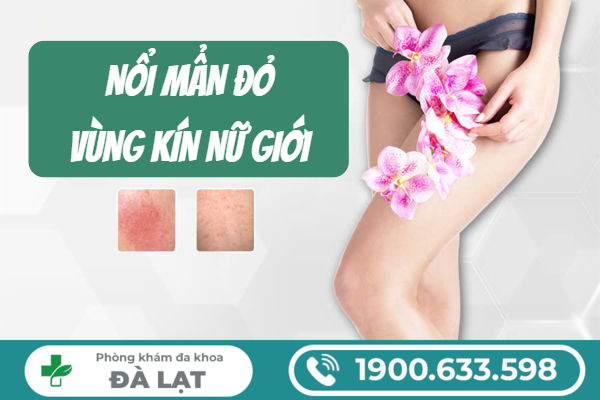 Hình ảnh minh họa